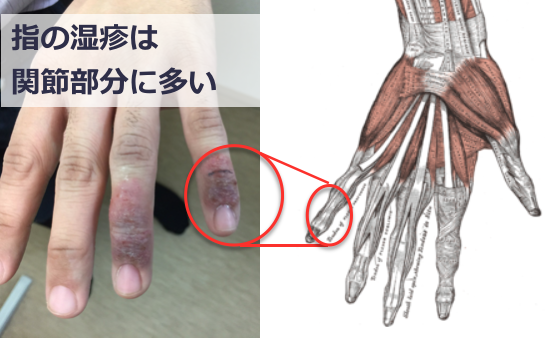 指の湿疹の特徴