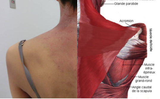 肩甲骨周囲の湿疹