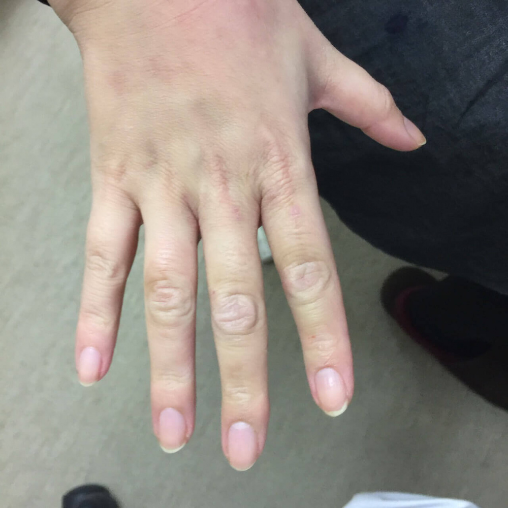 手指の湿疹 症例1 15 川崎市多摩区のアトピー専門整体 英気治療院