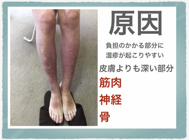 脛の湿疹の原因