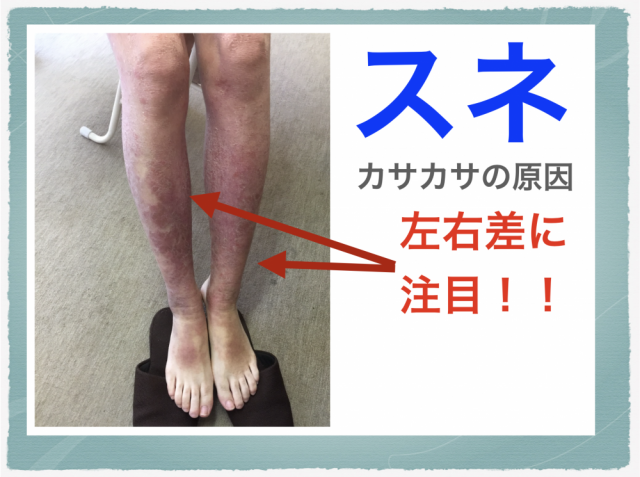 すねのかゆみと糖尿病