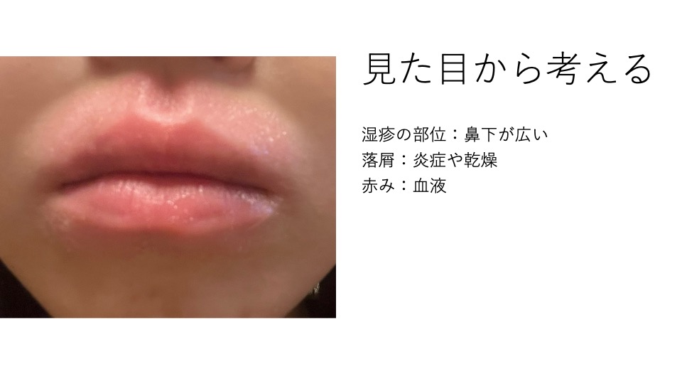 半年続く口周りの湿疹の原因を考察 川崎市多摩区のアトピー専門整体 英気治療院