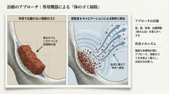 手技では届かない骨のキワにこびりついた老廃物を、超音波とキャビテーションで粉砕。血流に乗せて体外へ排出することで、炎症の元を断ちます 。
