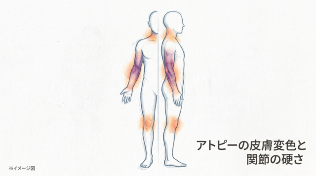 アトピーの皮膚変色と関節の硬さ：温熱刺激と生理的間隙の補正による改善プロセスの考察