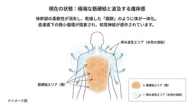 人体の背面図。背中の中央に「筋硬結エリア」としてオレンジ色の領域があり、その周囲を囲むように「痒み波及エリア」を示す水色の同心円状の波紋が複数描かれている。