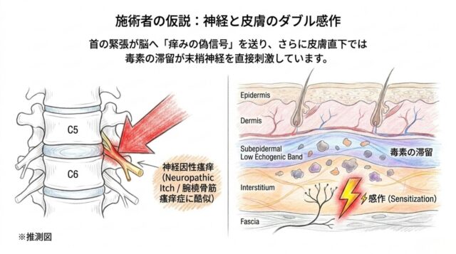 左側にC5・C6頸椎と神経根を指し示す赤い大きな矢印。右側に皮膚の多層構造の断面図があり、組織の中にグレーの石のような「毒素」が浮遊し、神経末端の近くで赤い稲妻マークが「感作」として描かれている。