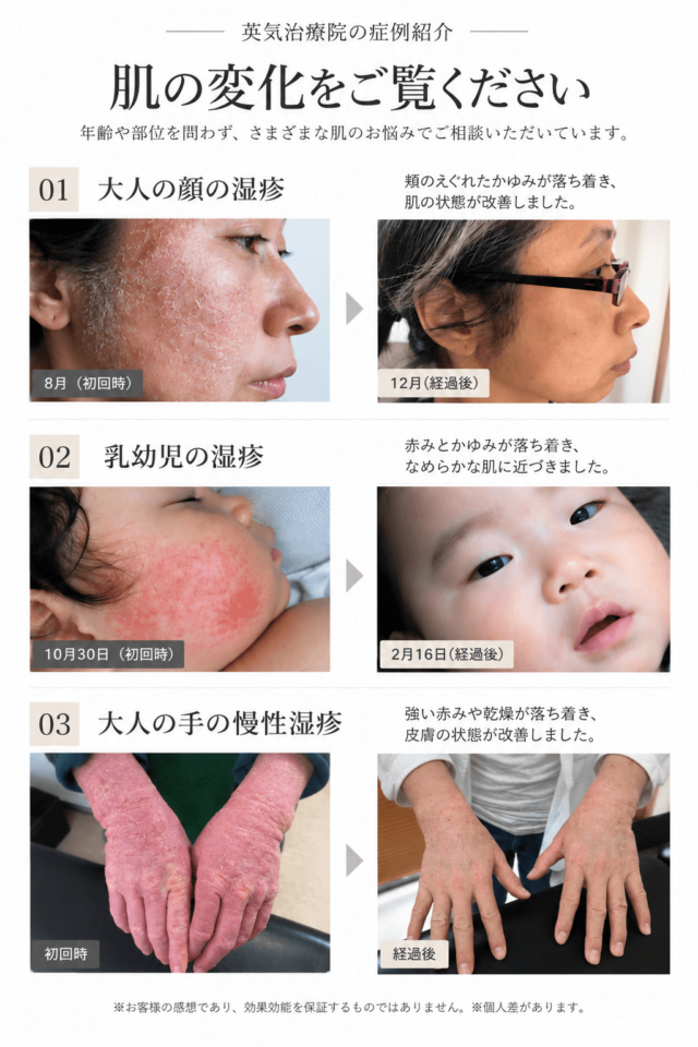 「英気治療院の症例紹介 肌の変化をご覧ください」。大人の顔の湿疹、乳幼児の湿疹、大人の手の慢性湿疹について、初回時と経過後の改善の様子を比較したビフォーアフター写真。